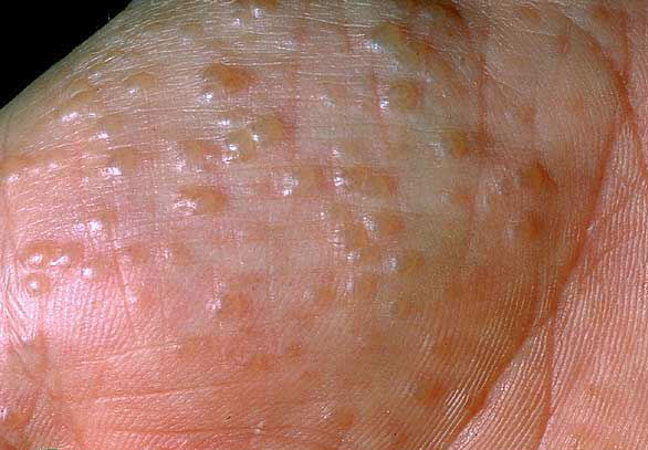 Dermatosis papulosa nigra | DermNet New Zealand